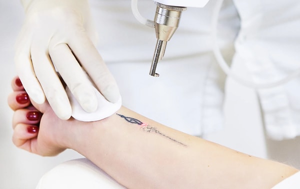 6. Когда вы удаляете татуировку лазером, чернила не исчезают и не растворяются, а выводятся вместе с мочой