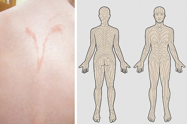 15. Кожа человека покрыта узором, называемым линиями Блашко