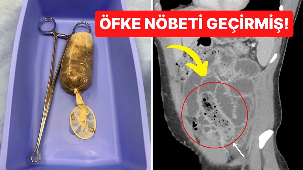 Bu Kez Fantezi İçin Değil! İçi Muz Dolu Bir Prezervatifi Bütün Halde Yutup Hastanelik Olan Tuhaf Adam