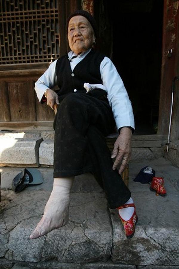 Günümüzde yaşayan 86 yaşındaki Zhou Guizhen bu küçük ayak geleneğini yaşatan son insanlardan biri.