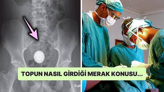 Kendi İmkanlarıyla Çıkartamayınca Bağırsağındaki Golf Topu ile Acil Servise Başvuran Çocuk Doktorları Şaşırttı