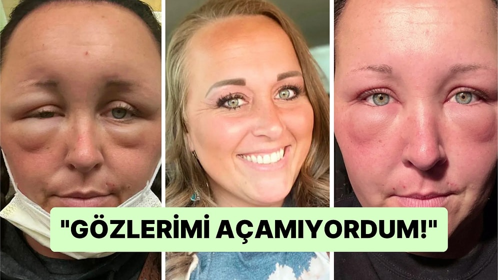 Evde Kendi İmkanlarıyla Saçını Boyadıktan Sonra Bir Anda Hayatı Kabusa Dönen Kadının Şoke Eden Görüntüleri