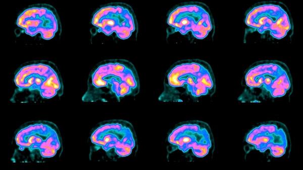 Şu anda, Alzheimer teşhisi beyinde üç farklı özelliğin tanımlanmasını gerektirmekte.