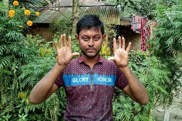22 yaşındaki Apu Sarker ailesiyle birlikte Bangladeş'in kuzeyindeki Rajshahi bölgesinde bir köyde yaşamakta.