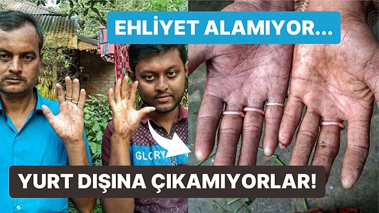 Bu Ailedeki Erkeklerin Parmak İzi Yok! Bangladeşli Sarker Ailesinin Adermatoglifiya ile İmtihanı