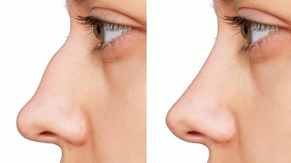 1. Rhinoplasty