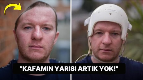 Kafasına Yediği Yumruk Yüzünden Kafatasının Yarısı Alınan Adamın Açıklamaları: "Korku İçinde Yaşıyorum..."