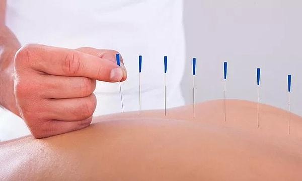 3. Akupunktur yöntemiyle stres ve kaygıdan kurtulabilir miyiz?