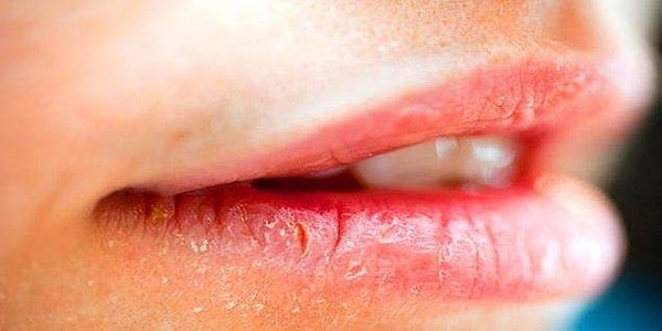 3. Don't forget to protect your lips from the sun!