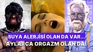 Su Alerjisinden Aylar Süren Orgazma Bilim Dünyasını Bile Dumura Uğratan Dünyanın En Tuhaf 25 Hastalığı!