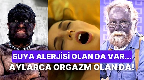 Su Alerjisinden Aylar Süren Orgazma Bilim Dünyasını Bile Dumura Uğratan Dünyanın En Tuhaf 25 Hastalığı!