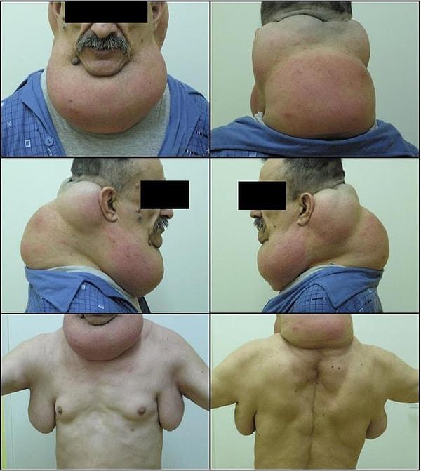 9. Genetik bir rahatsızlık olan Madelung deformitesine sahip bir adam.