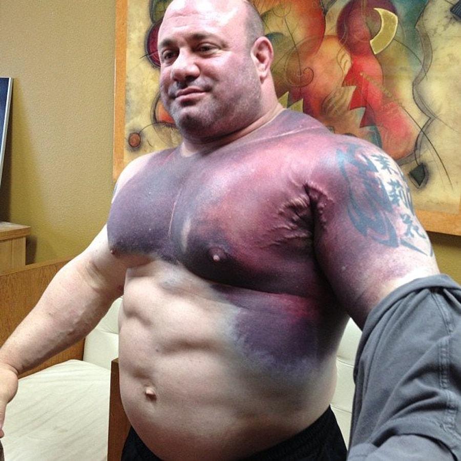 гематома на груди у мужчин фото 3