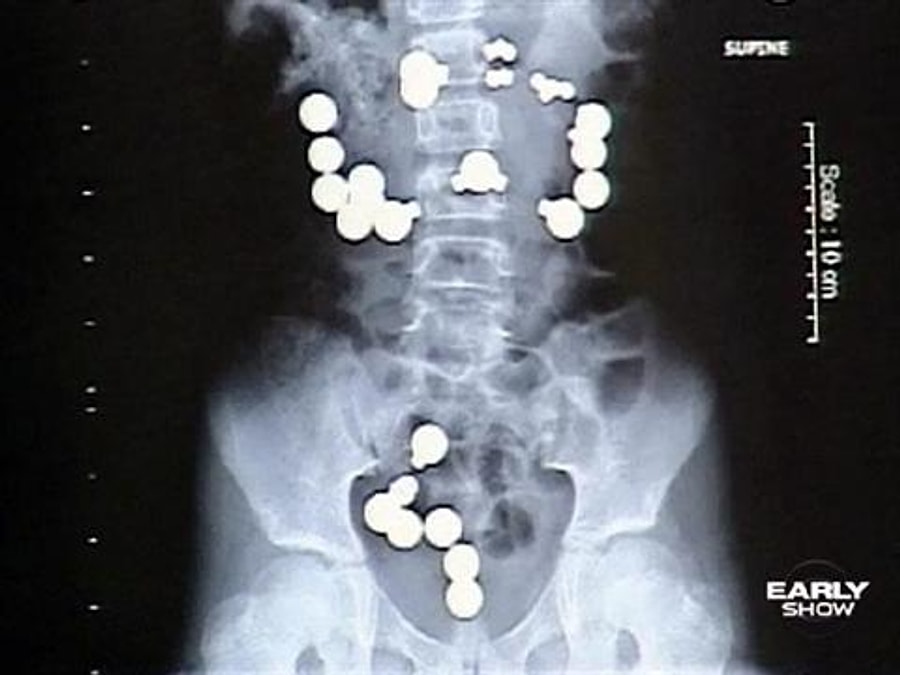 Магнитные шарики на рентгене. Магнитные шарики в кишечнике. Рентгеноскопия наркотиков. Рентген проглотивших магнитный шарика.