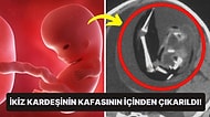 Akıllara Durgunluk Veren Ameliyat: Çin'de 1 Yaşındaki Kızın Kafatasından Doğmamış İkiz Kardeşi Çıkarıldı!
