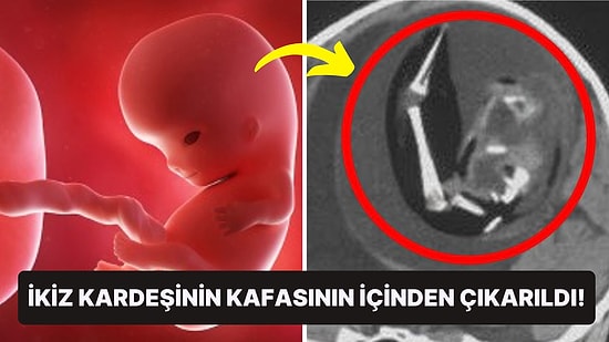 Akıllara Durgunluk Veren Ameliyat: Çin'de 1 Yaşındaki Kızın Kafatasından Doğmamış İkiz Kardeşi Çıkarıldı!