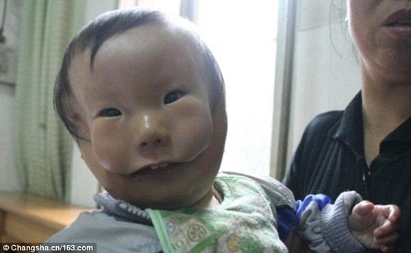 12. Zhao Huikang, Çin'in Hunan eyaletinde çok ilginç bir deformasyonla dünyaya geldi. Kendisi 2010 yılından bu yana 'maskeli çocuk' olarak adlandırılıyor.