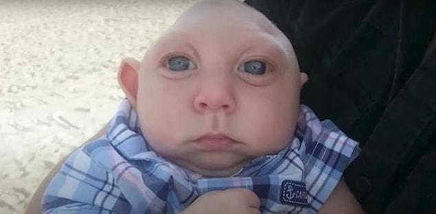 14. Jaxon Buell isimli bebeğin doğduğunda beyninin %80'i yoktu! Doktorlar her ne kadar bir kaç ay ömür biçse de Jaxon, 5 yaşına kadar yaşadı.