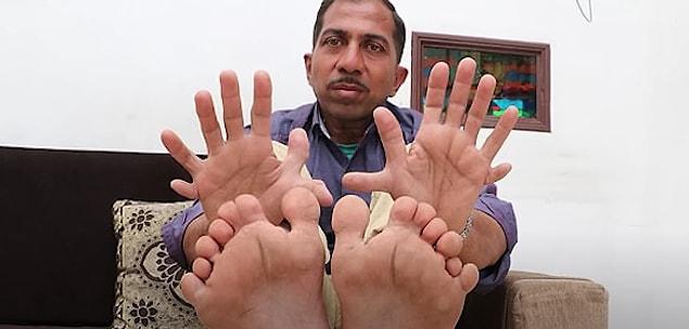 15. Ve son olarak Devendra Suthar da ilginç bir deformasyona sahip. Kendisinin ellerinde 14, ayaklarında 14 olmak üzere toplamda 28 parmağı var!