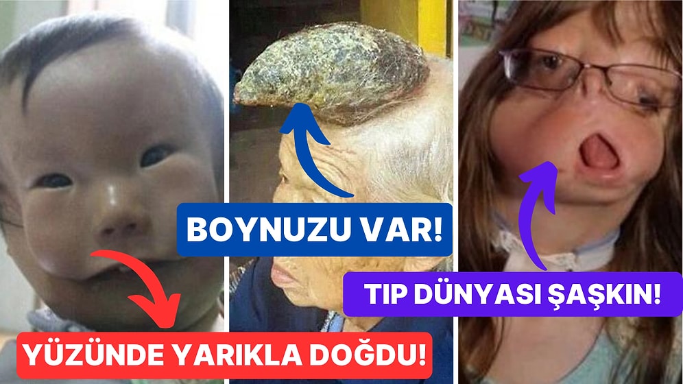 Daha Önce Hiçbir Yerde Duymadığınızı İddia Ettiğimiz Tıp Dünyasını Bile Şaşkına Çeviren 15 Hastalık