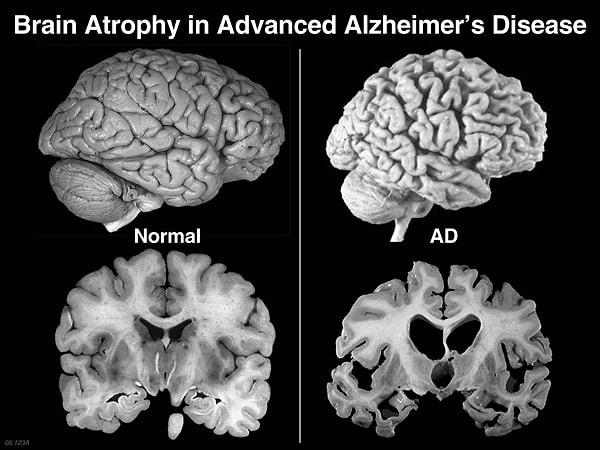 Çalışma sırasında Akdeniz diyetini en yakından takip eden katılımcılarda Alzheimer teşhisi neredeyse yüzde 40'tan daha azdı ve beyinleri önemli ölçüde daha az bilişsel gerileme belirtisi gösterdi.