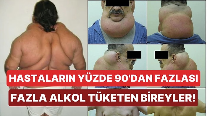 Fazla Alkolün Sebep Olduğu ve Kas Ağrılarıyla Ortaya Çıkan En İlginç Hastalıklardan Biri: Madelung