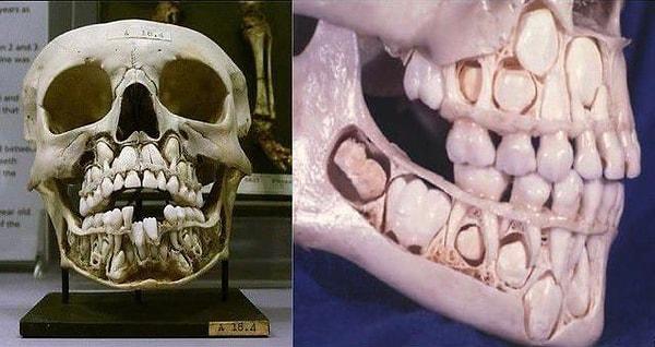 1. Süt dişleri dökülmeden önce bir çocuğun kafatası böyle gözükür 👇