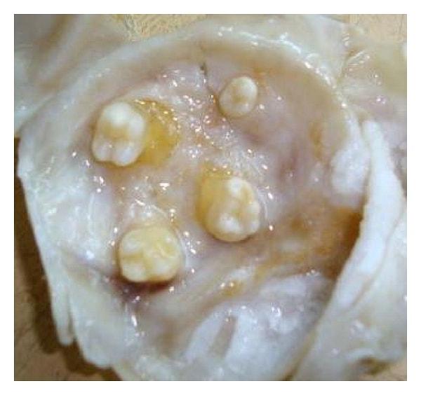 7. Bir kadının yumurtalıklarında ve bir erkeğin testislerinde dişlerin büyümesine neden olabilen bir tür tümör vardır.