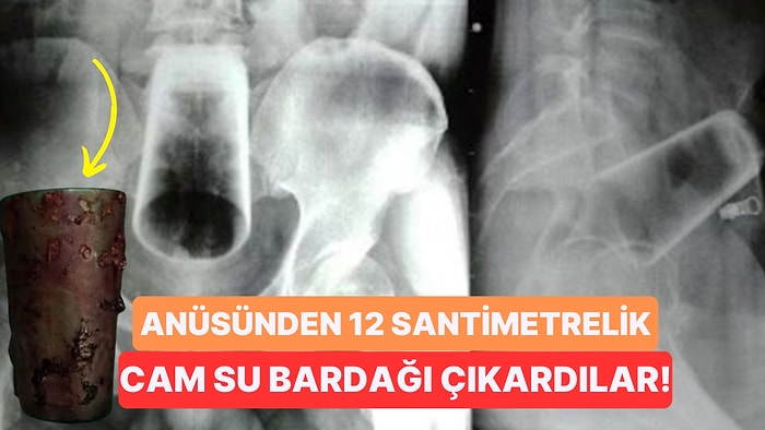 Anüsünden Koca Bir Su Bardağı Çıktı! Bardakla Fantezi Yapan Adamın Akıllara Sığmayan İlginç Hikayesi