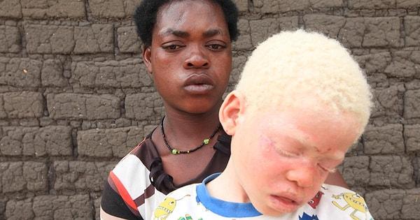Bazı Afrika ülkelerinde albino kişilerin "şans getireceğine" inanılarak kaçırılması çok görülen bir olay. Bu sefer de olayın olduğu yer Mozambik.