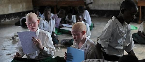 Günümüzde halk hikayeleri, büyücülük, zengin olma ayinleri gibi hurafeler yüzünden Afrika kıtasındaki albinoların sosyal hayat şartları oldukça olumsuz. İstatistiklere göre albinoların % 98’i kolayca önlenebilecek hastalıklar yüzünden 40 yaşına gelmeden ölüyor.