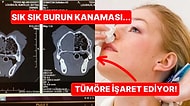 Burun Kanamaları Neden Kaynaklanır ve Hangi Durumlarda Korkmanız Gerekiyor?