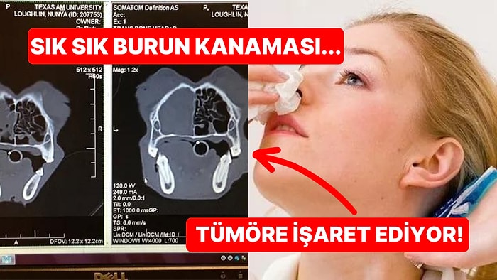 Burun Kanamaları Neden Kaynaklanır ve Hangi Durumlarda Korkmanız Gerekiyor?