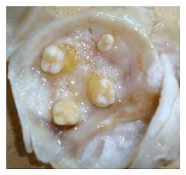 4. Bir kadının yumurtalıklarında ve bir erkeğin testislerinde dişlerin büyümesine neden olabilen bir tür tümör vardır.