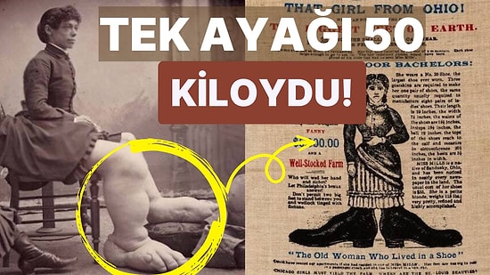 “Fil Ayaklı” Diye Alay Ediyorlardı: Sirklerde Gösteri Yapmaya Zorlanan Fanny Mills'in Trajik Hikayesi