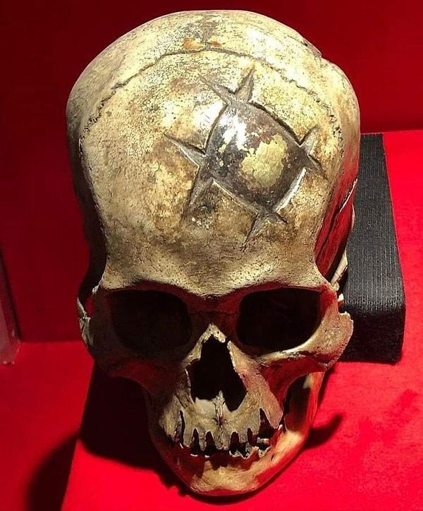 3. Peru'da M.S. 400 yıllarından kalma bir kranioplasti (kafatasının bozukluğunu düzeltme ameliyatı) örneği...