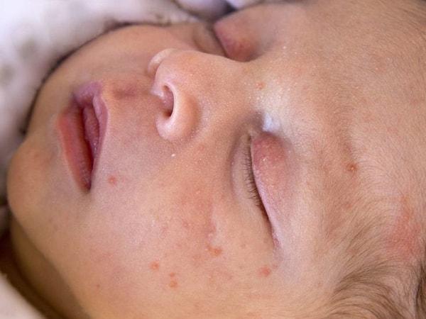 Bebek akneleri, her bebekte görülebilen bir cilt rahatsızlığı. Her ne kadar çok korkutucu görünse de aslında bunlar bebeklerde çok yaygın.