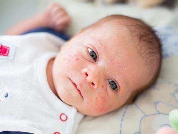 Yenidoğan evresi geçtikten sonrakilere ise bebek aknesi deniliyor. Bebekler 6 hafta olduktan sonra ortaya çıkan bu bebek akneleri asıl olarak 3-6 aylık bebeklerde ortaya çıkabiliyor.