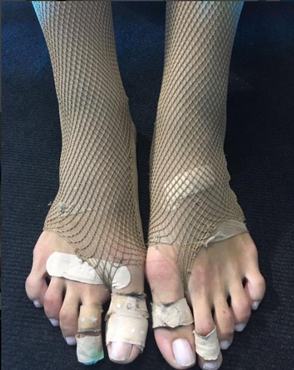 Daha önce özel bir gecede dans gösterisi yaptıktan sonra ayaklarının halini paylaşan Erçel yeniden ayaklarıyla gündemde.