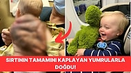 Oldukça Nadir Görülen Bir Cilt Hastalığıyla Doğan Bebeğin Yürek Burkan Hikayesi