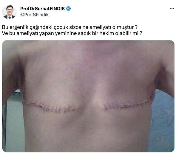 Prof. Dr. Serhat Fındık'ın söz konusu paylaşımı işte bu. Kendisi yabancı bir siteden alınan bu görseli, sanki bir çocuğun cinsiyet geçiş operasyonu sonrasına aitmiş gibi paylaştı.