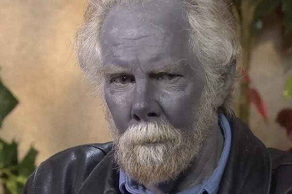 Стоит отметить, что он делал он это для лечения хронического синуса, дерматита и кислотного рефлюкса, от которых он никак не мог избавиться