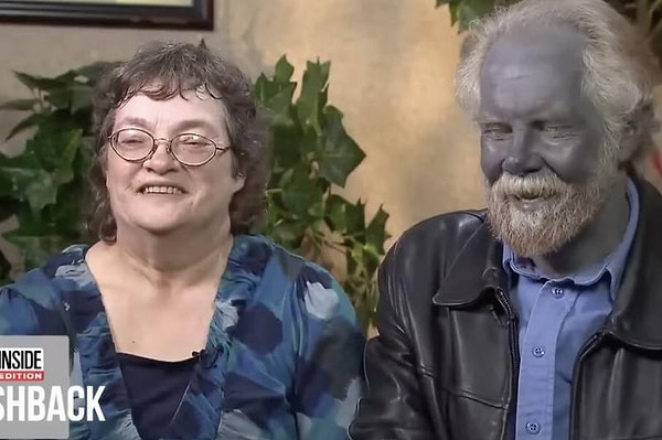 То, что произошло с Папой Смурфом, называется аргирия. Она может появится при употреблении определенных пищевых добавок