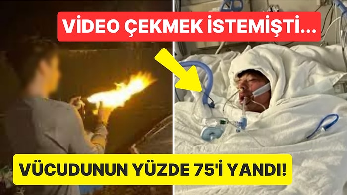 TikTok Akımına Katılayım Derken Canından Oluyordu: Vücudunun Yüzde 75'i Yanan 16 Yaşındaki Çocuk Gündemde!