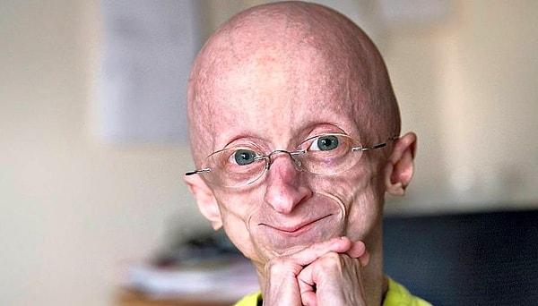 Bilemedin, Hutchinson-Gilford Progeria Sendromu değil!