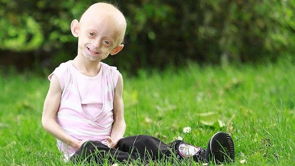 11. Progeria