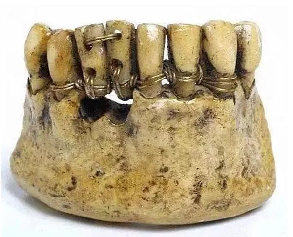 12. Antik Roma'da bir diş tedavisi eseri...