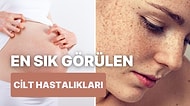 Yeni Anneler Buraya! Hamilelik Sonrası Ortaya Çıkabilen Cilt Hastalıkları
