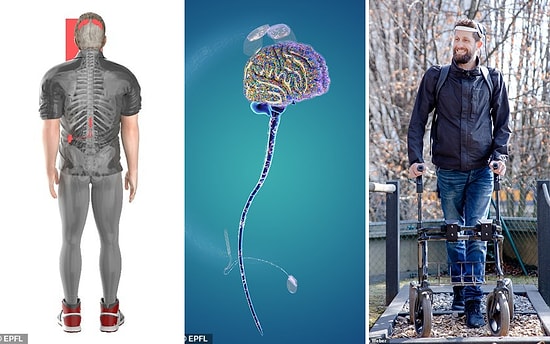 Парализованный мужчина впервые за 12 лет начал ходит после того, как ему вживили имплант, читающий мысли