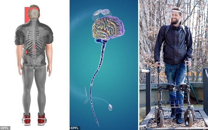 Парализованный мужчина впервые за 12 лет начал ходит после того, как ему вживили имплант, читающий мысли